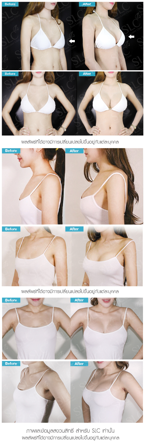 Breast Augmentation Surgery Body Clinic Service SLC Clinic