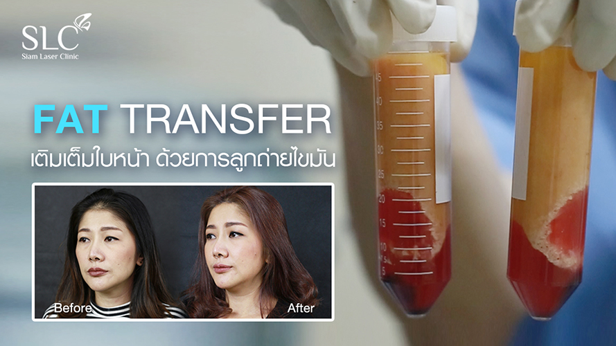 Fat transfer by SLC | รีวิวจากผู้รับบริการจริง คุณนุช