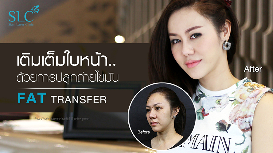 Fat transfer by SLC | รีวิวจากผู้รับบริการจริง คุณมุ้ย