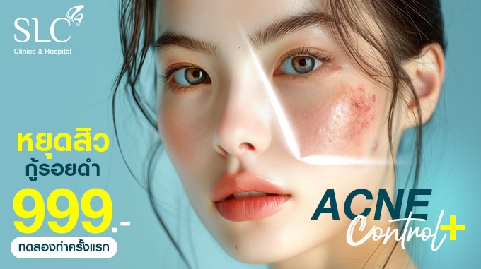 ด่วนก่อนหมดสิทธิ์ ! Acne Control Plus+ หยุดสิว กู้รอยดำ ทดลองครั้งแรกเพียง 999.-