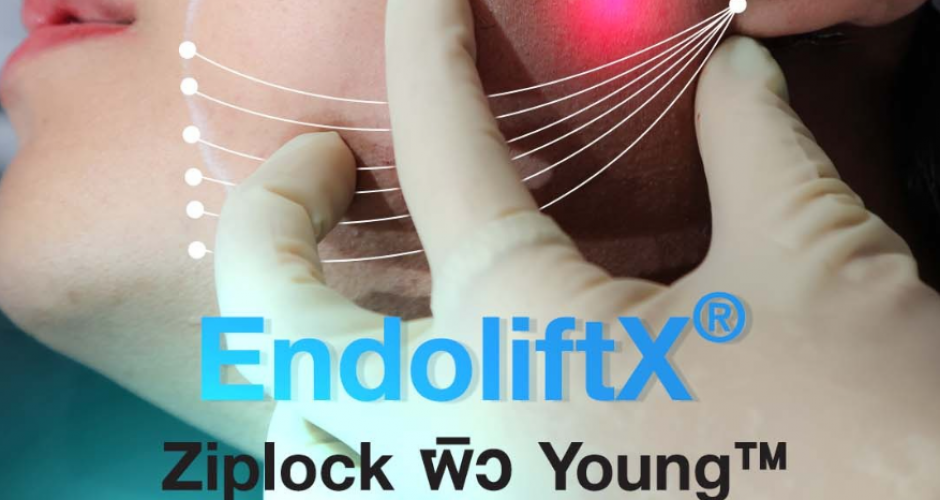 โปรแกรม EndoliftX® เลเซอร์ยกกระชับด้วยแสง ล็อคผิว Young™