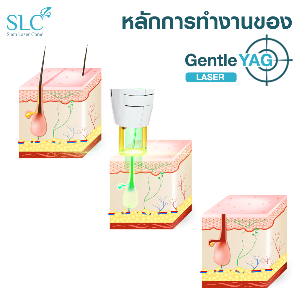 Gentle YAG Pro-U , กำจัดขน Gentle YAG Pro U , Gentle YAG Pro U ดียังไง , Gentle YAG Pro-U SLC , กำจัดขน SLC , เลเซอร์ขนSLC