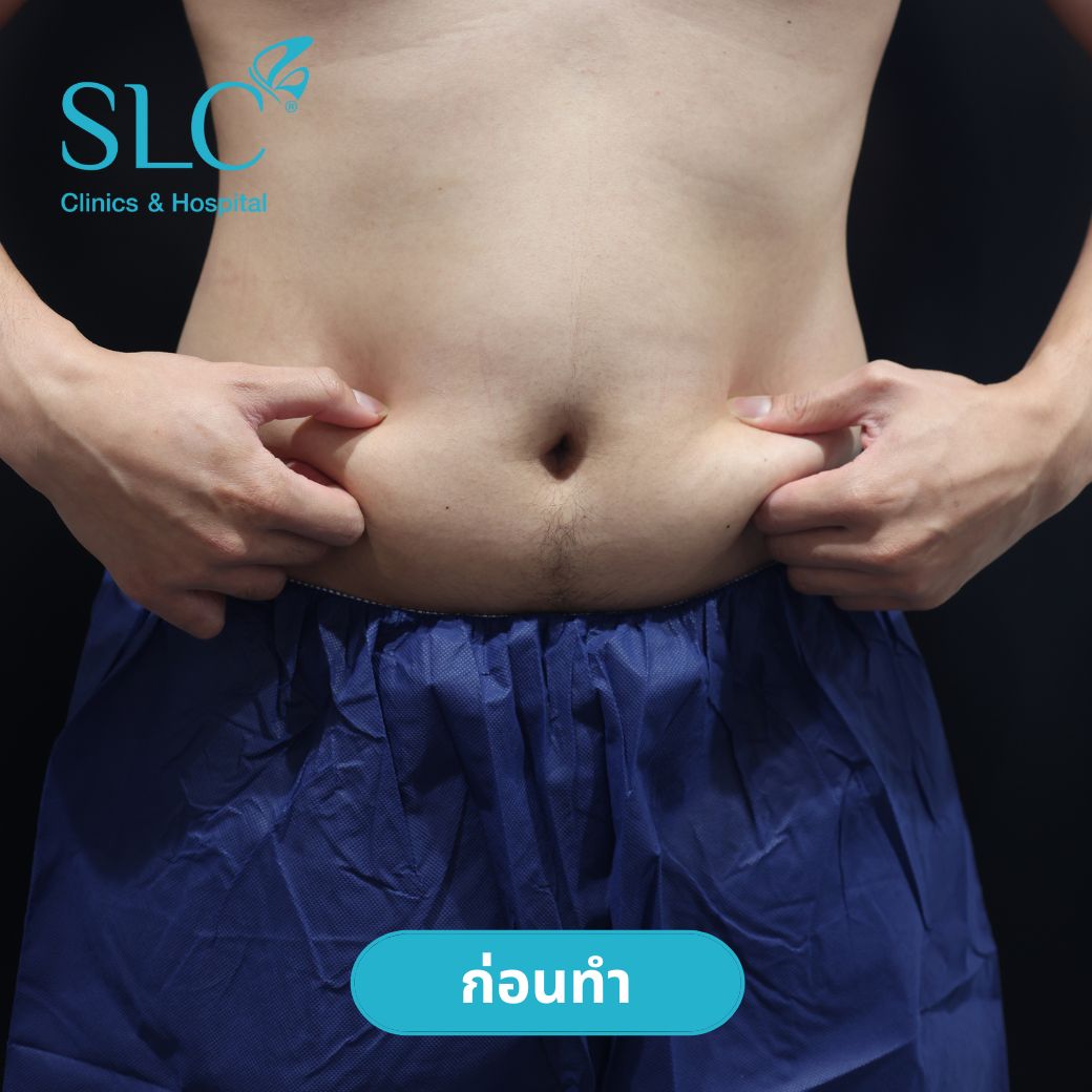 ลดพุงหมาน้อย, Coolsculpting® ELITE, Coolsculpting, ลดพุง, ลงพุงลดยังไง, วิธีลดพุงเร่งด่วน, วิธีลดพุงง่ายๆ, ลดพุงหน้าท้องเร่งด่วน,วิธีลดพุงแบบไม่ออกกําลังกาย