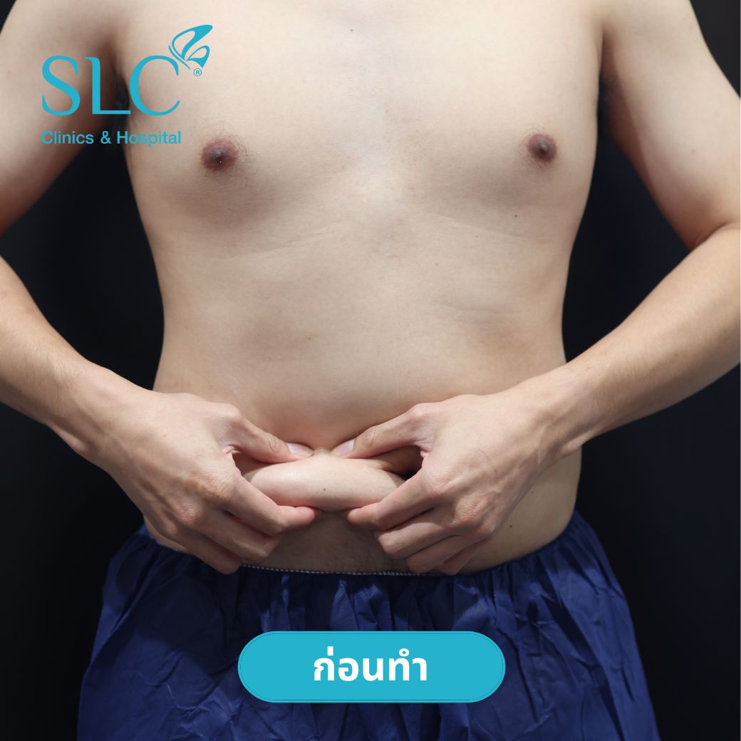 ลดพุงหมาน้อย, Coolsculpting® ELITE, Coolsculpting, ลดพุง, ลงพุงลดยังไง, วิธีลดพุงเร่งด่วน, วิธีลดพุงง่ายๆ, ลดพุงหน้าท้องเร่งด่วน,วิธีลดพุงแบบไม่ออกกําลังกาย