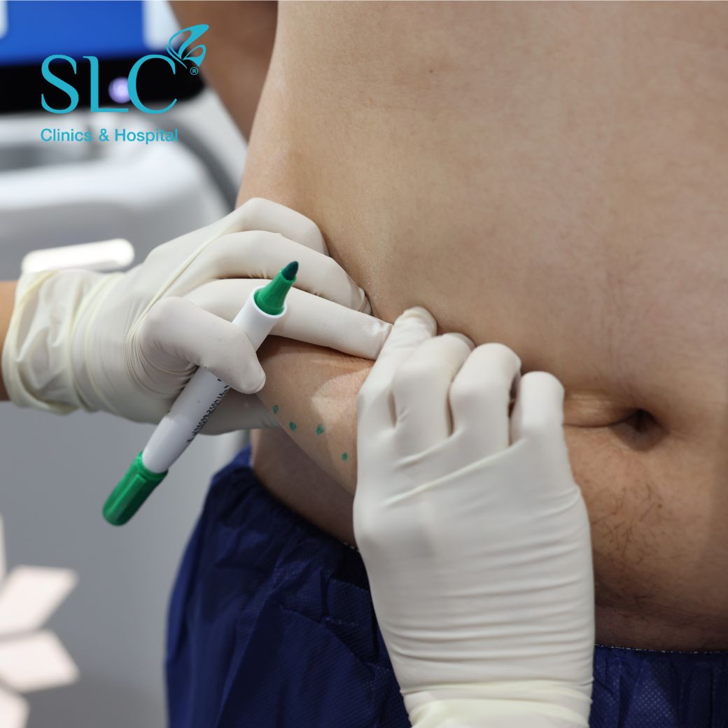 ลดพุงหมาน้อย, Coolsculpting® ELITE, Coolsculpting, ลดพุง, ลงพุงลดยังไง, วิธีลดพุงเร่งด่วน, วิธีลดพุงง่ายๆ, ลดพุงหน้าท้องเร่งด่วน,วิธีลดพุงแบบไม่ออกกําลังกาย