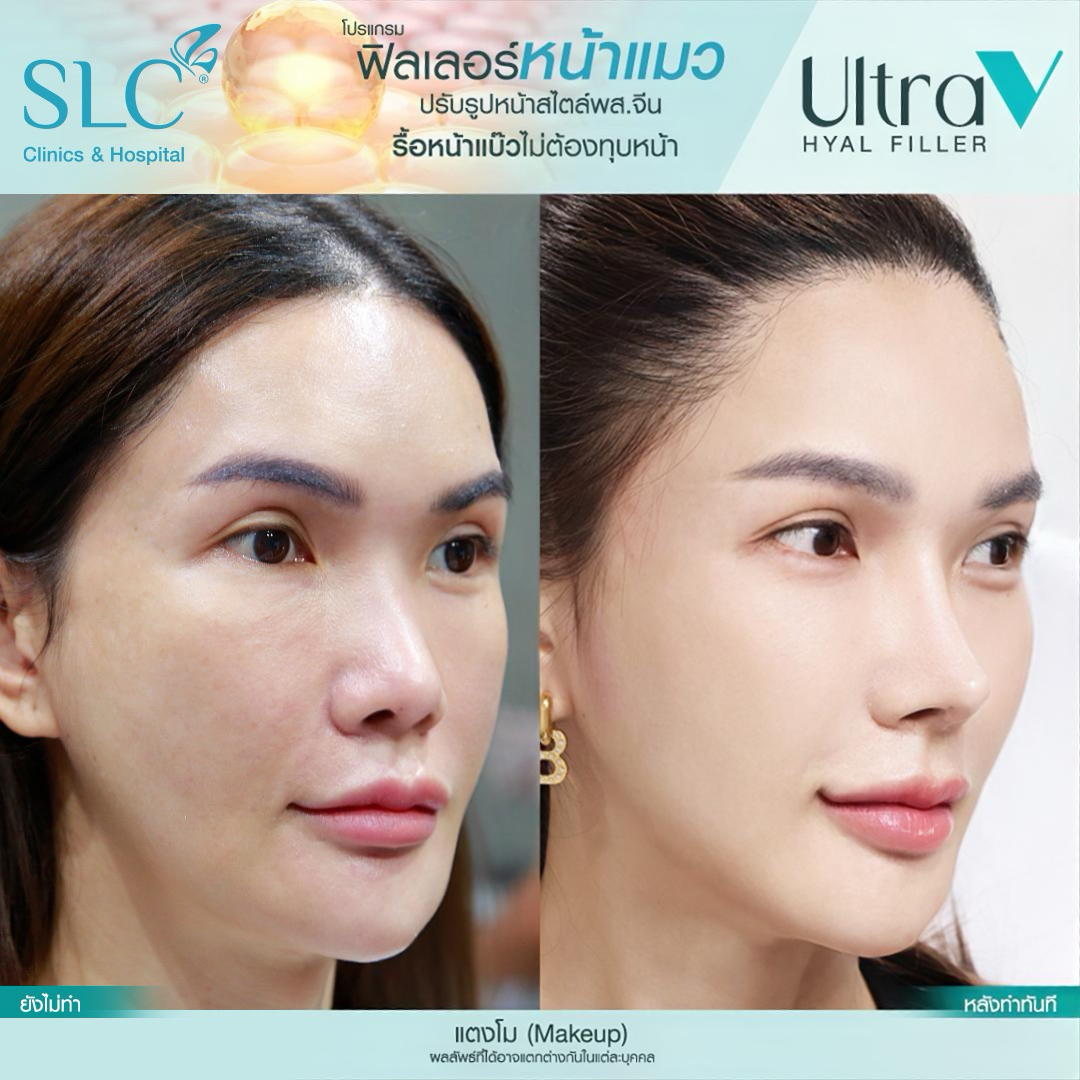 Ultra V Hyal Filler, ฟิล พส จีน