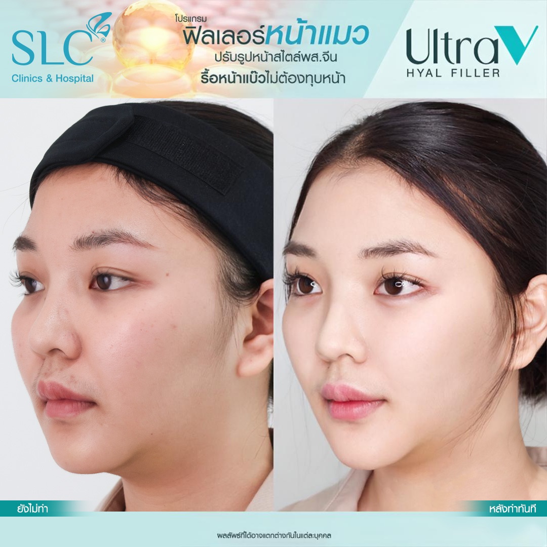 Ultra V Hyal Filler, ฟิล พส จีน