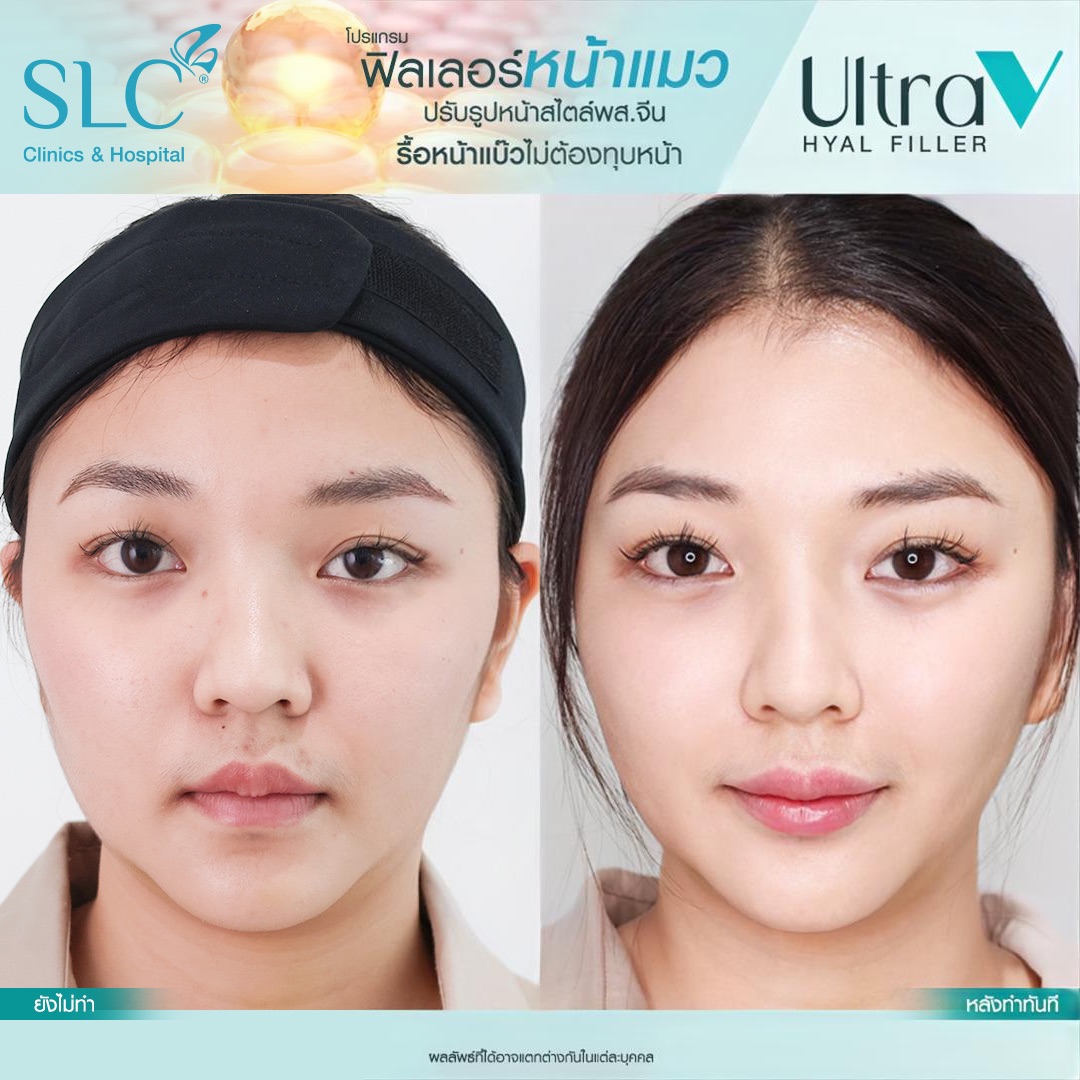 Ultra V Hyal Filler, ฟิล พส จีน