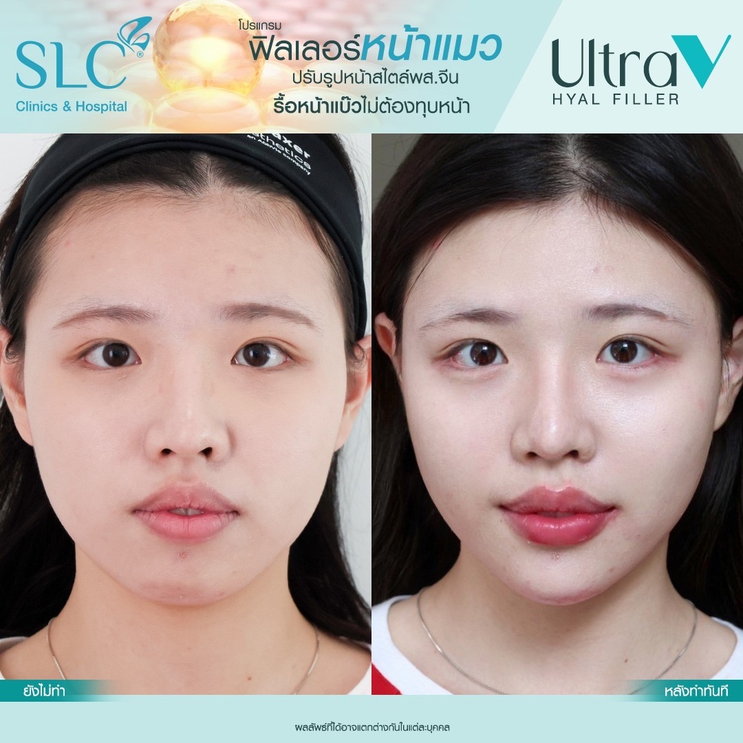 Ultra V Hyal Filler, ฟิล พส จีน