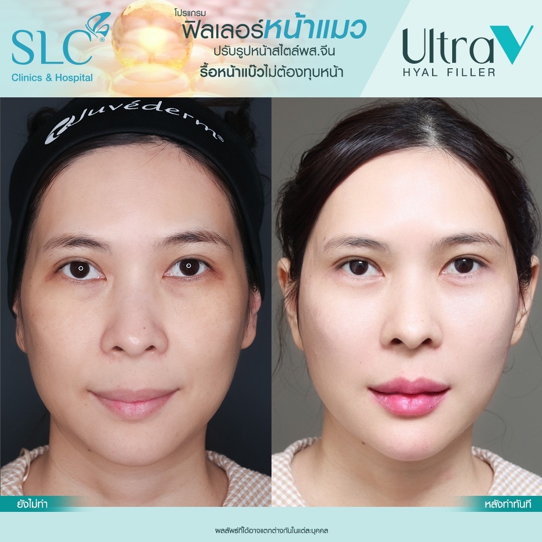 Ultra V Hyal Filler, ฟิล พส จีน