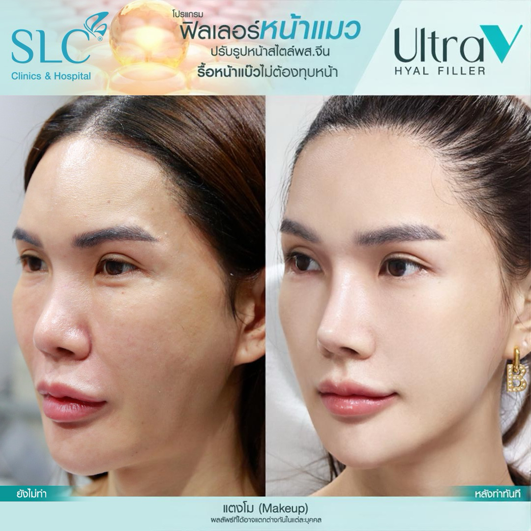 Ultra V Hyal Filler, ฟิล พส จีน