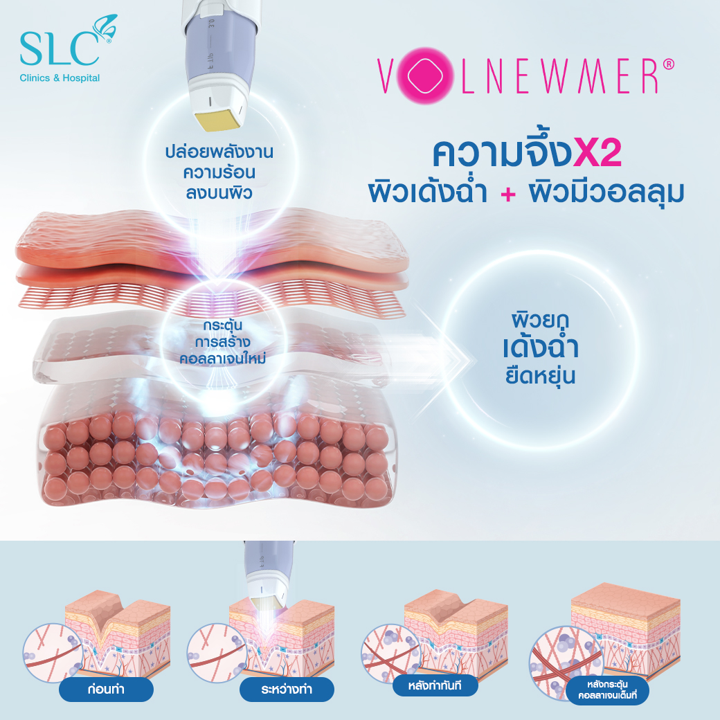  เครื่องยกหน้า, เครื่องยกกระชับ, ยกกระชับหน้า, Ulthera, Volnewmer, MPT 4 D Lift, Emface, Morpheus 8, Thermage, หัตถการยกกระชับหน้า, เครื่องยกกระชับหน้า