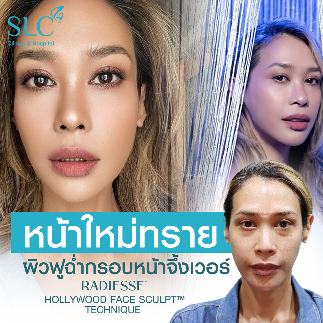 รีวิว Radiesse, Radiesse ดีไหม, เรเดียสดีไหม, รีวิวเรเดียส, หน้าแห้ง, ผิวยับ, ผิวหย่อนคล้อย