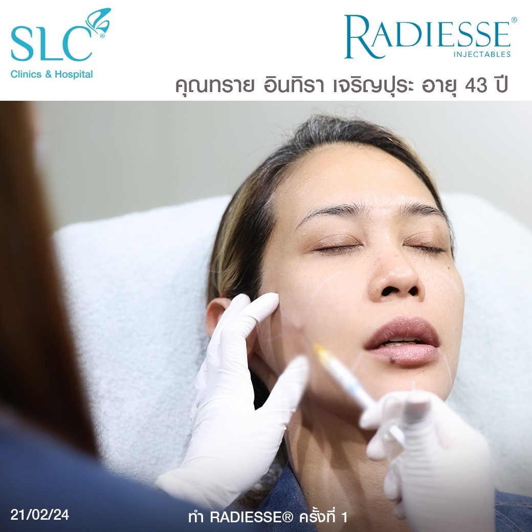 รีวิว Radiesse, Radiesse ดีไหม, เรเดียสดีไหม, รีวิวเรเดียส, หน้าแห้ง, ผิวยับ, ผิวหย่อนคล้อย