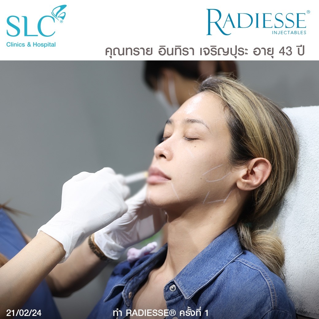 รีวิว Radiesse, Radiesse ดีไหม, เรเดียสดีไหม, รีวิวเรเดียส, หน้าแห้ง, ผิวยับ, ผิวหย่อนคล้อย