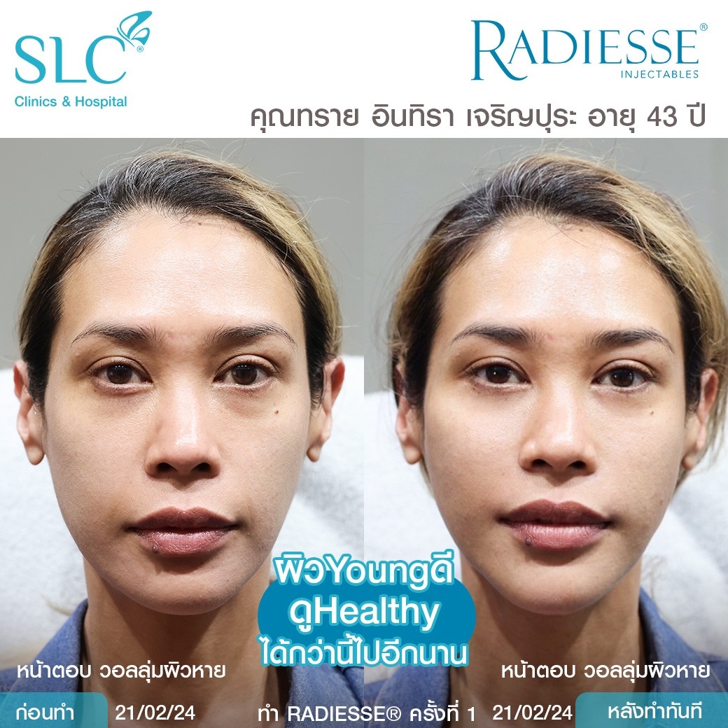 รีวิว Radiesse, Radiesse ดีไหม, เรเดียสดีไหม, รีวิวเรเดียส, หน้าแห้ง, ผิวยับ, ผิวหย่อนคล้อย