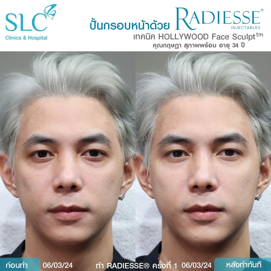 รีวิว Radiesse, Radiesse ดีไหม, เรเดียสดีไหม, รีวิวเรเดียส, หน้าแห้ง, ผิวยับ, ผิวหย่อนคล้อย