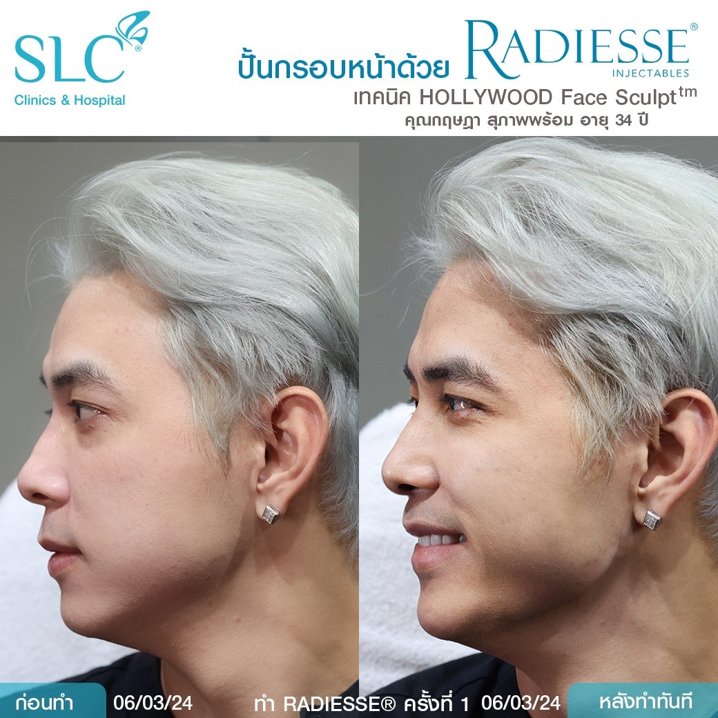 รีวิว Radiesse, Radiesse ดีไหม, เรเดียสดีไหม, รีวิวเรเดียส, หน้าแห้ง, ผิวยับ, ผิวหย่อนคล้อย