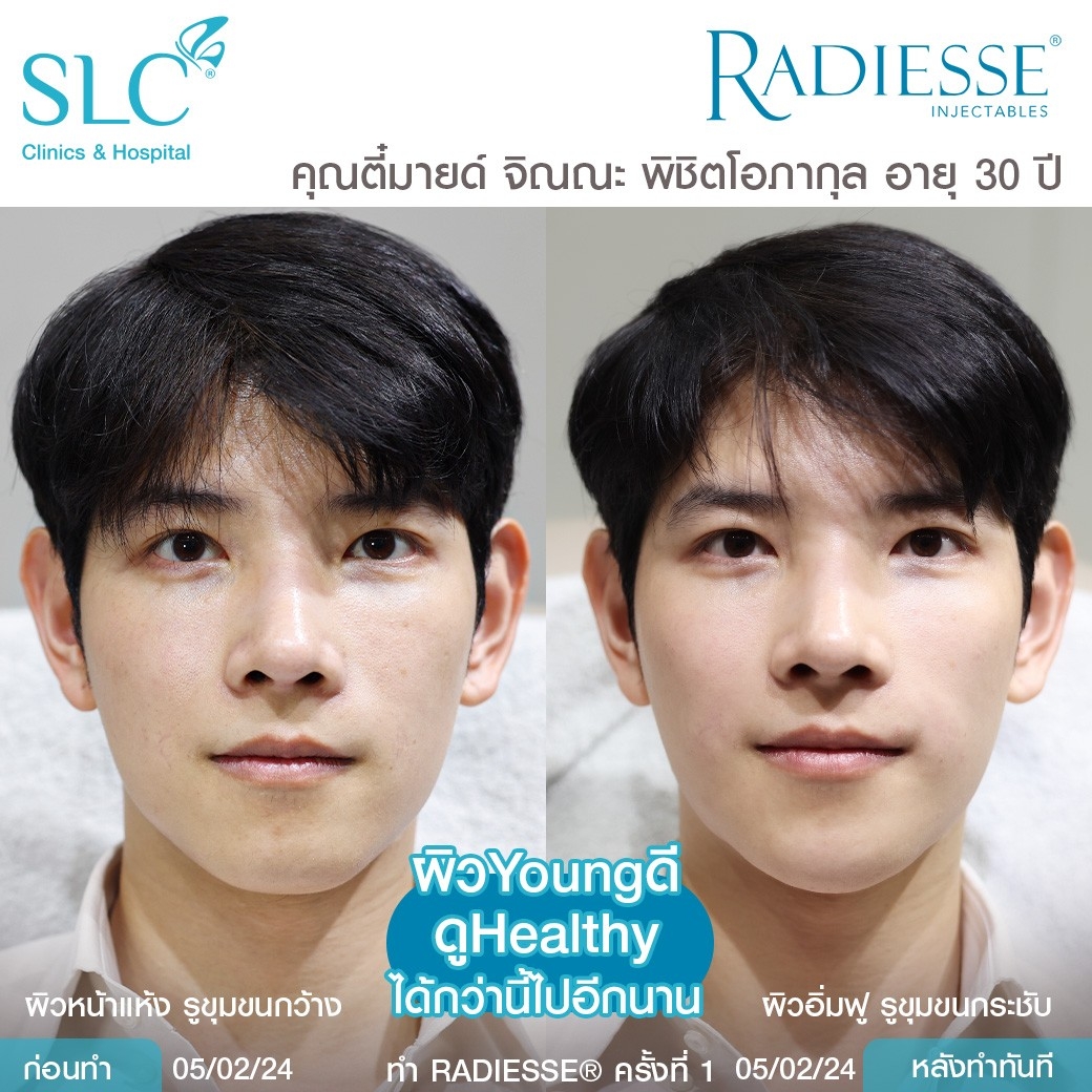 รีวิว Radiesse, Radiesse ดีไหม, เรเดียสดีไหม, รีวิวเรเดียส, หน้าแห้ง, ผิวยับ, ผิวหย่อนคล้อย