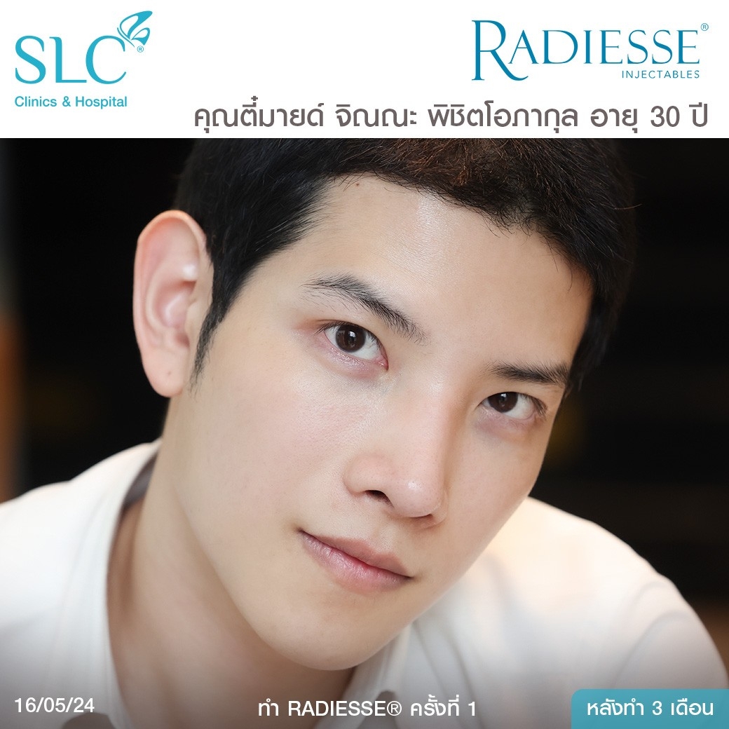 รีวิว Radiesse, Radiesse ดีไหม, เรเดียสดีไหม, รีวิวเรเดียส, หน้าแห้ง, ผิวยับ, ผิวหย่อนคล้อย