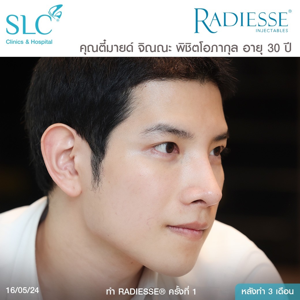 รีวิว Radiesse, Radiesse ดีไหม, เรเดียสดีไหม, รีวิวเรเดียส, หน้าแห้ง, ผิวยับ, ผิวหย่อนคล้อย