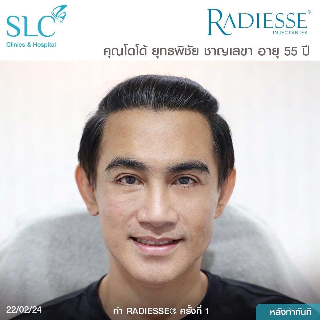 รีวิว Radiesse, Radiesse ดีไหม, เรเดียสดีไหม, รีวิวเรเดียส, หน้าแห้ง, ผิวยับ, ผิวหย่อนคล้อย