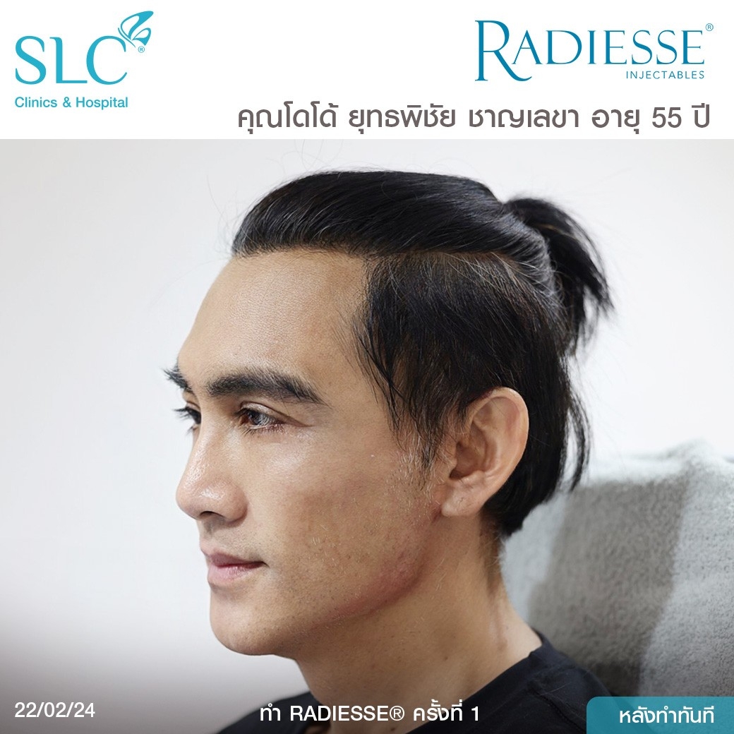 รีวิว Radiesse, Radiesse ดีไหม, เรเดียสดีไหม, รีวิวเรเดียส, หน้าแห้ง, ผิวยับ, ผิวหย่อนคล้อย