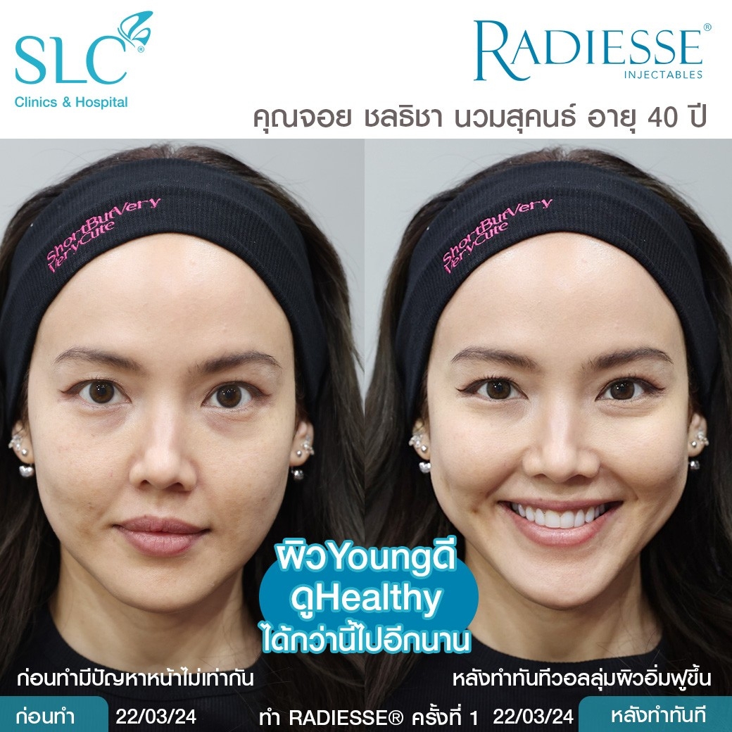 รีวิว Radiesse, Radiesse ดีไหม, เรเดียสดีไหม, รีวิวเรเดียส, หน้าแห้ง, ผิวยับ, ผิวหย่อนคล้อย