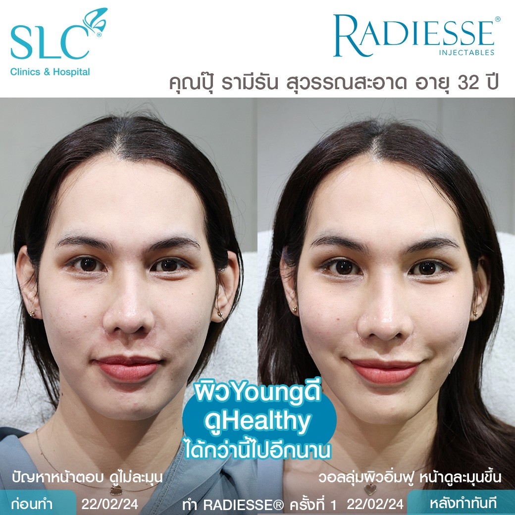 รีวิว Radiesse, Radiesse ดีไหม, เรเดียสดีไหม, รีวิวเรเดียส, หน้าแห้ง, ผิวยับ, ผิวหย่อนคล้อย