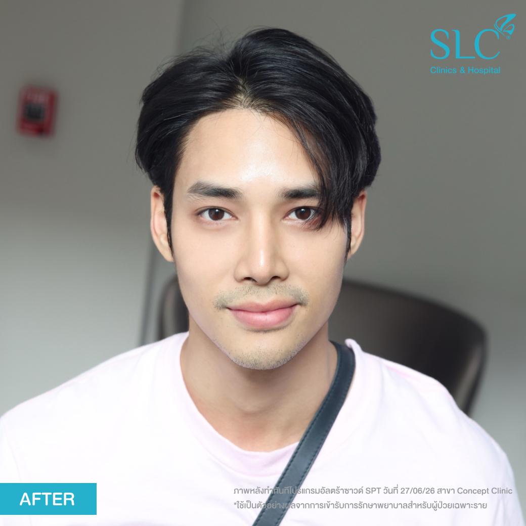 เด่นคุณ , ผู้ชายอยากดูดีต้องทําไง , โปรแกรมยกกระชับอัลตร้าซาวน์ SLC , รีวิวultheraslc