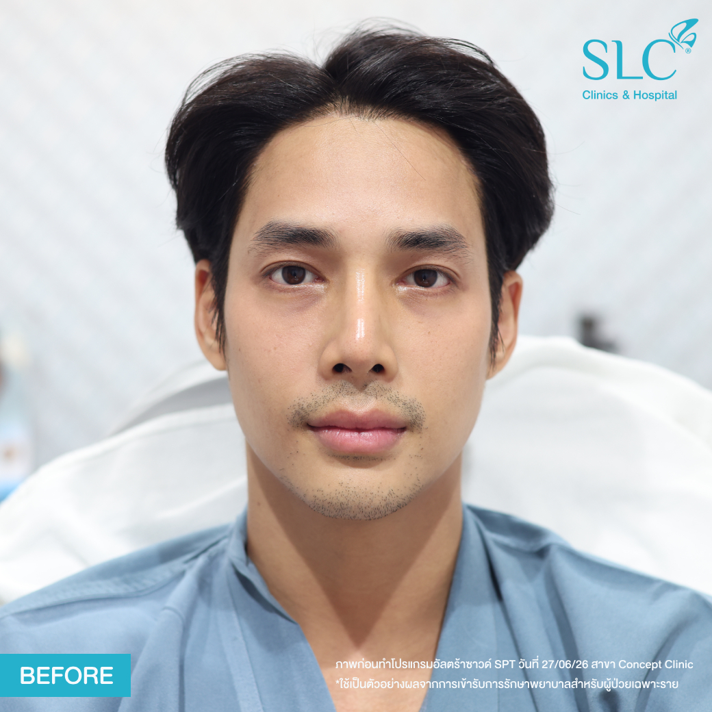 เด่นคุณ , ผู้ชายอยากดูดีต้องทําไง , โปรแกรมยกกระชับอัลตร้าซาวน์ SLC , รีวิวultheraslc