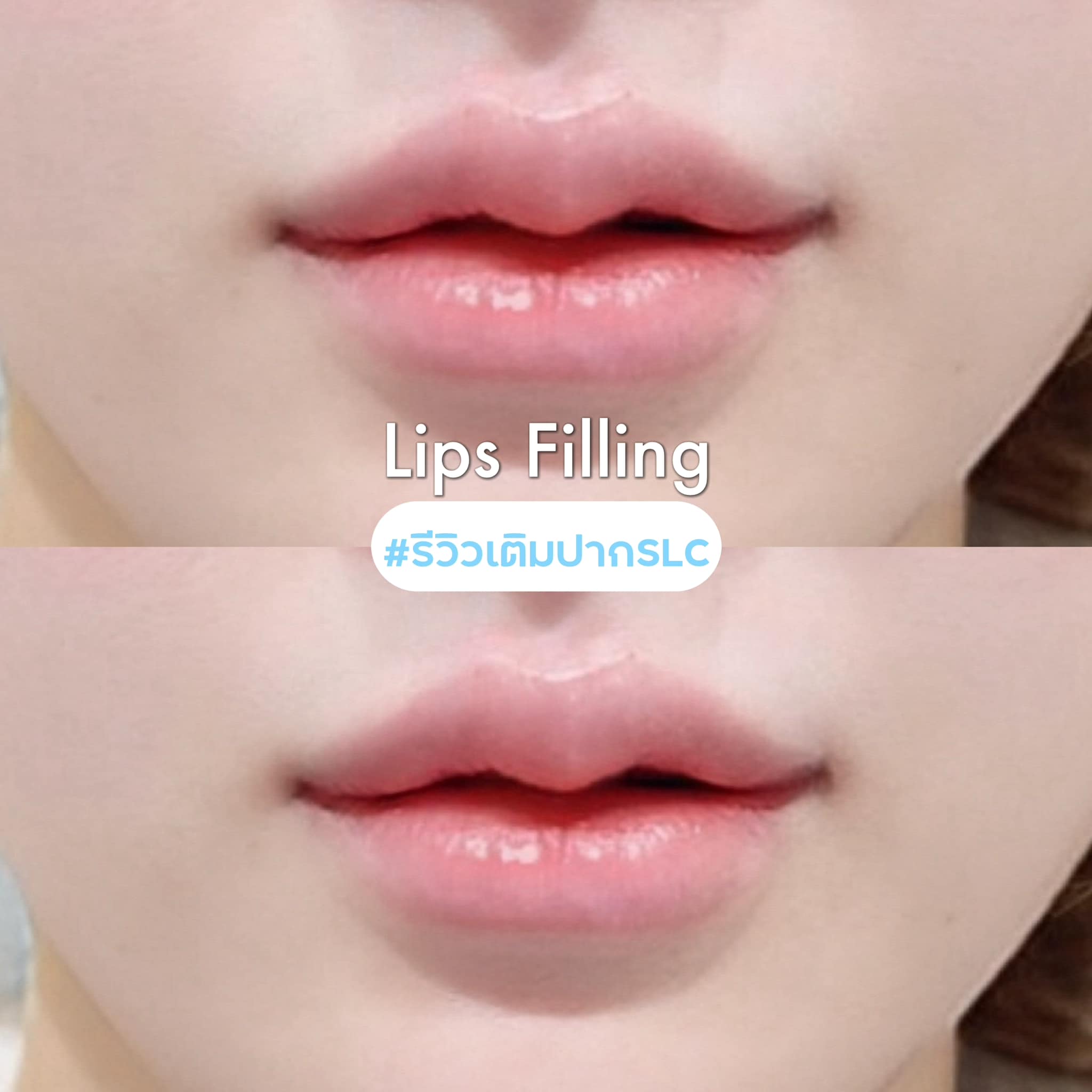 ทำโปรแกรมฉีดฟิลเลอร์ปาก, เติมปาก, Filler Bangkok, Thailand Clinic