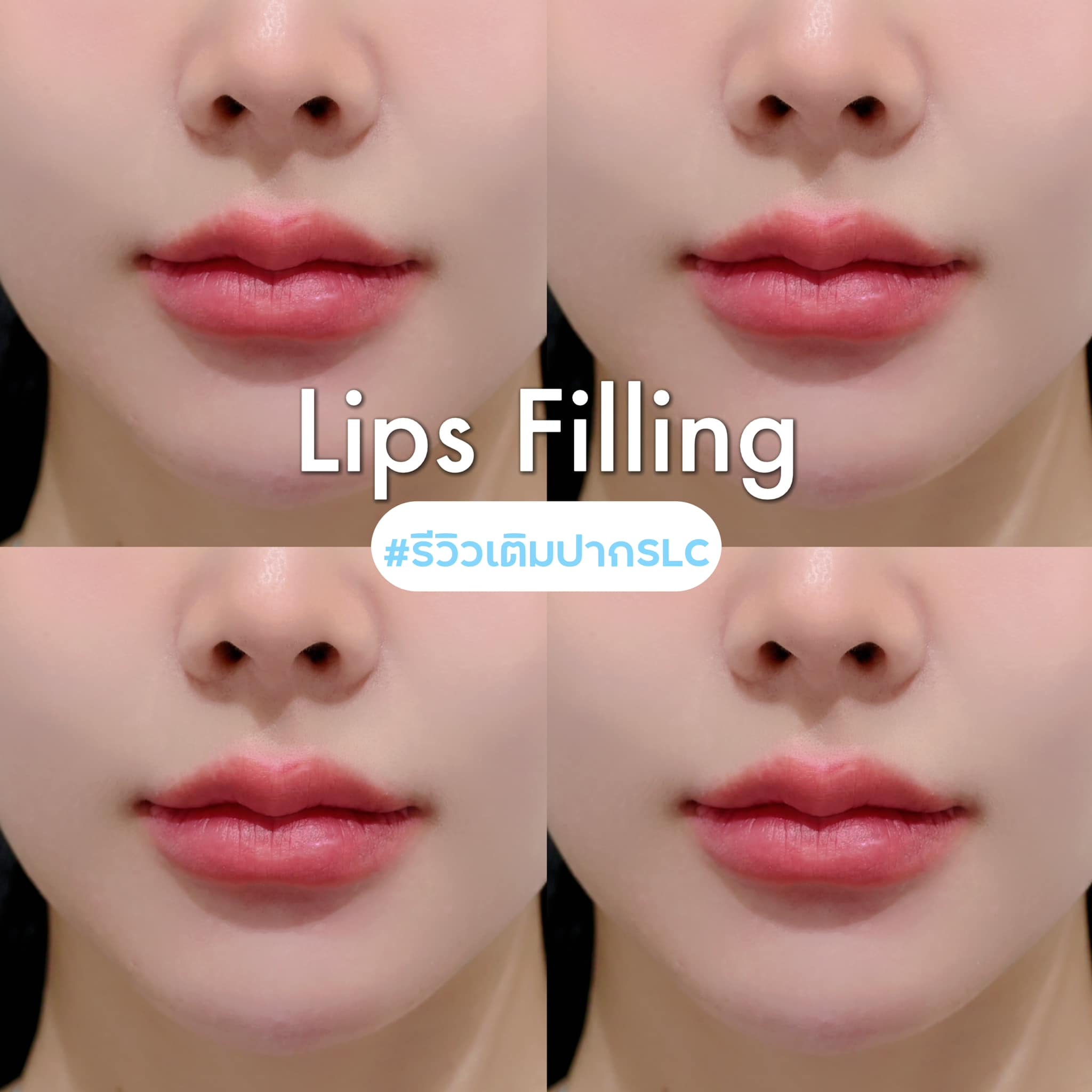 ทำโปรแกรมฉีดฟิลเลอร์ปาก, เติมปาก, Filler Bangkok, Thailand Clinic