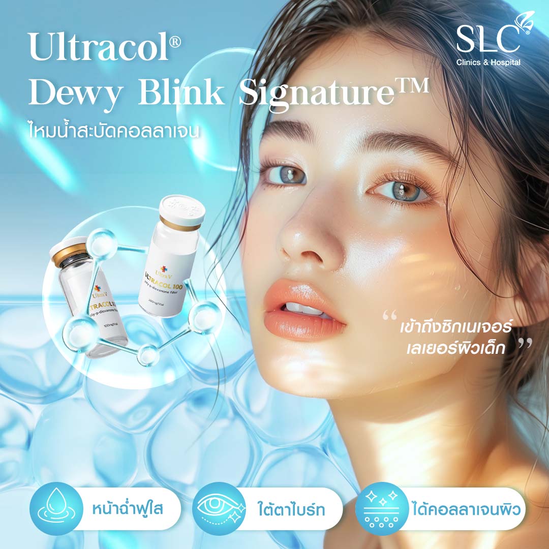 ไหมน้ำ, ไหมน้ำ SLC , SLC ไหมน้ำสะบัดคอลลาเจน, Ultracol 100 , ฉีดกระตุ้นคอลลาเจนผิว, Collagen Biostimulator, ไหมน้ำ คือ, ฉีดไหมน้ำ รีวิว, ultracol ใต้ตา