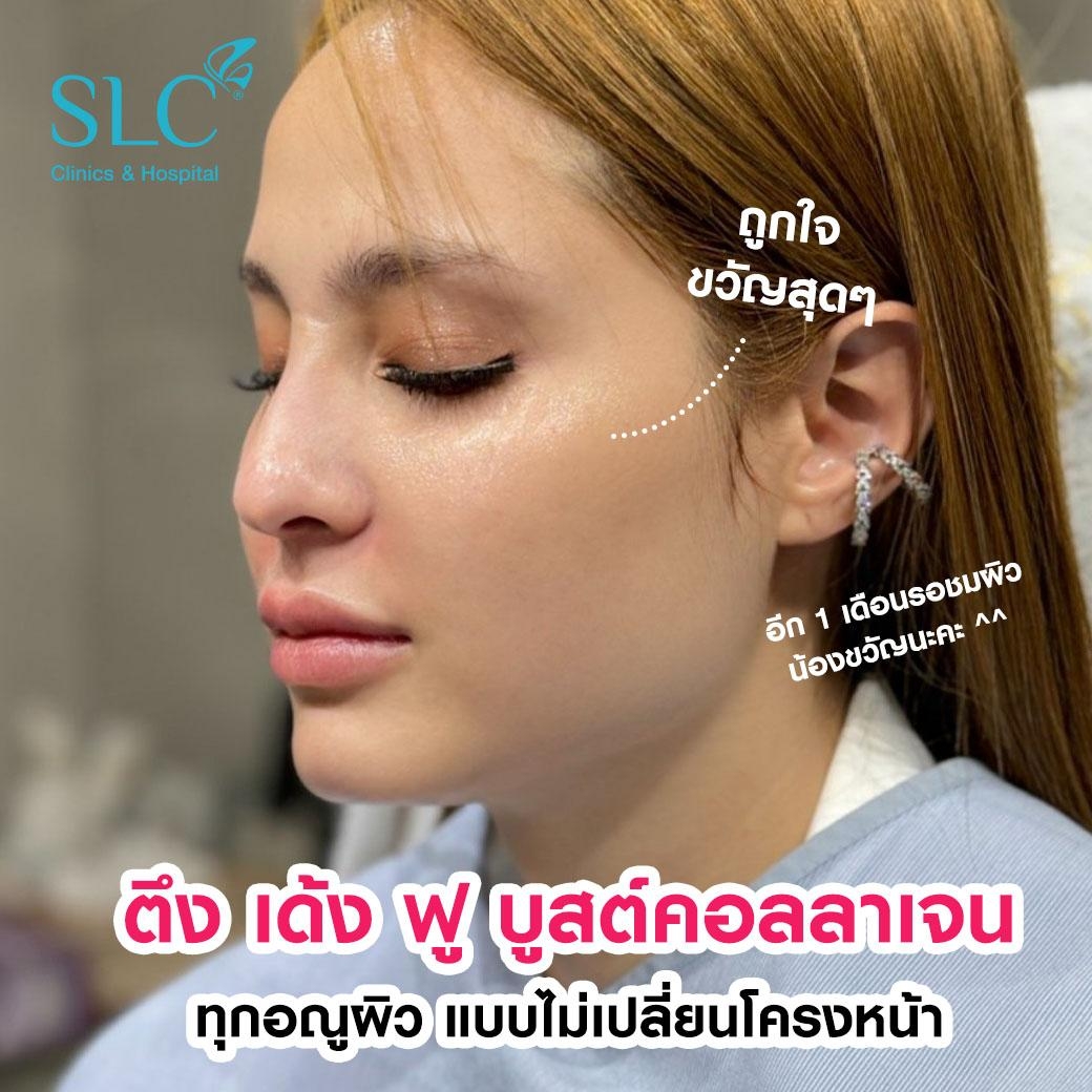 ฉีดคอลลาเจน, Sculptra, รีวิว Sculptra, รีวิวฉีดคอลลาเจน, รีวิวงานผิว, ขวัญอุษามณี, ขวัญอุษามณีฉีดหน้า, ขวัญอุษามณีจิ้มหน้า, ขวัญอุษามณีทำหน้า