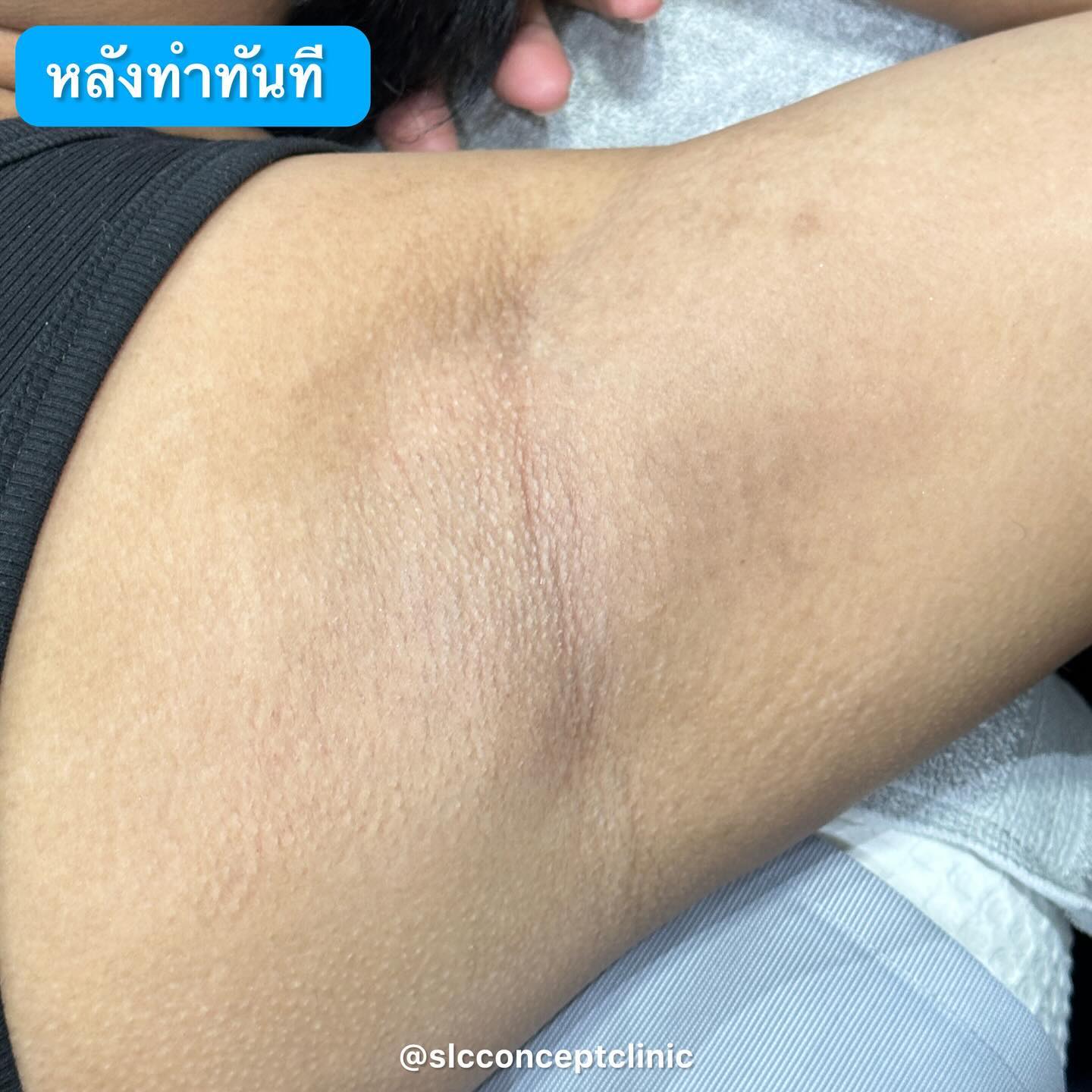 Wink Plus Armpit, White Armpit, รักแร้ขาว, เลเซอร์รักแร้,เลเซอร์ขน,กำจัดขน,รักแร้เนียนใส,แก้รักแร้ดำ, เลเซอร์รักแร้ขาว, รักแร้ดําแก้ยังไง, รักแร้ดําเกิดจากอะไร, รักษารักแร้ดํา,ทํายังไงให้รักแร้ขาว,  ทรีตเมนต์รักแร้ขาว, วิธีทำให้รักแร้ขาว