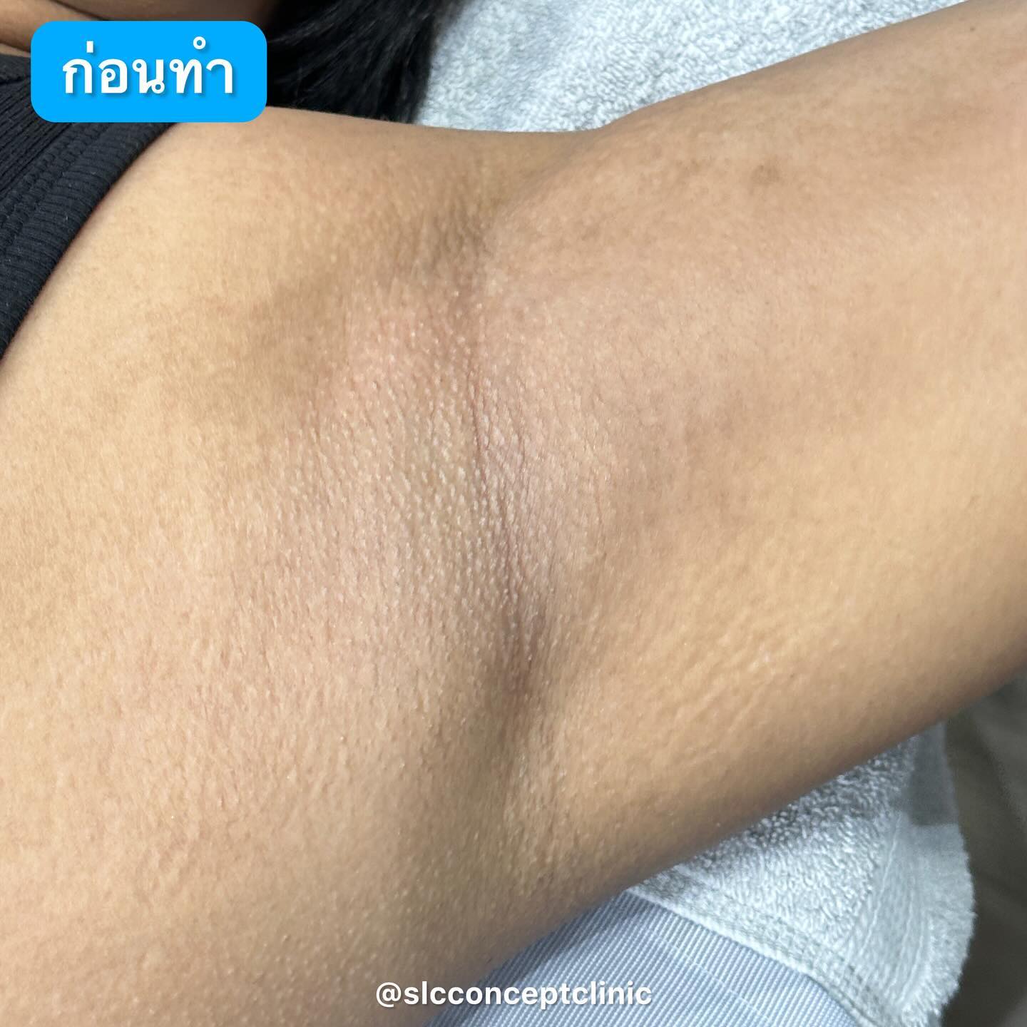 Wink Plus Armpit, White Armpit, รักแร้ขาว, เลเซอร์รักแร้,เลเซอร์ขน,กำจัดขน,รักแร้เนียนใส,แก้รักแร้ดำ, เลเซอร์รักแร้ขาว, รักแร้ดําแก้ยังไง, รักแร้ดําเกิดจากอะไร, รักษารักแร้ดํา,ทํายังไงให้รักแร้ขาว,  ทรีตเมนต์รักแร้ขาว, วิธีทำให้รักแร้ขาว