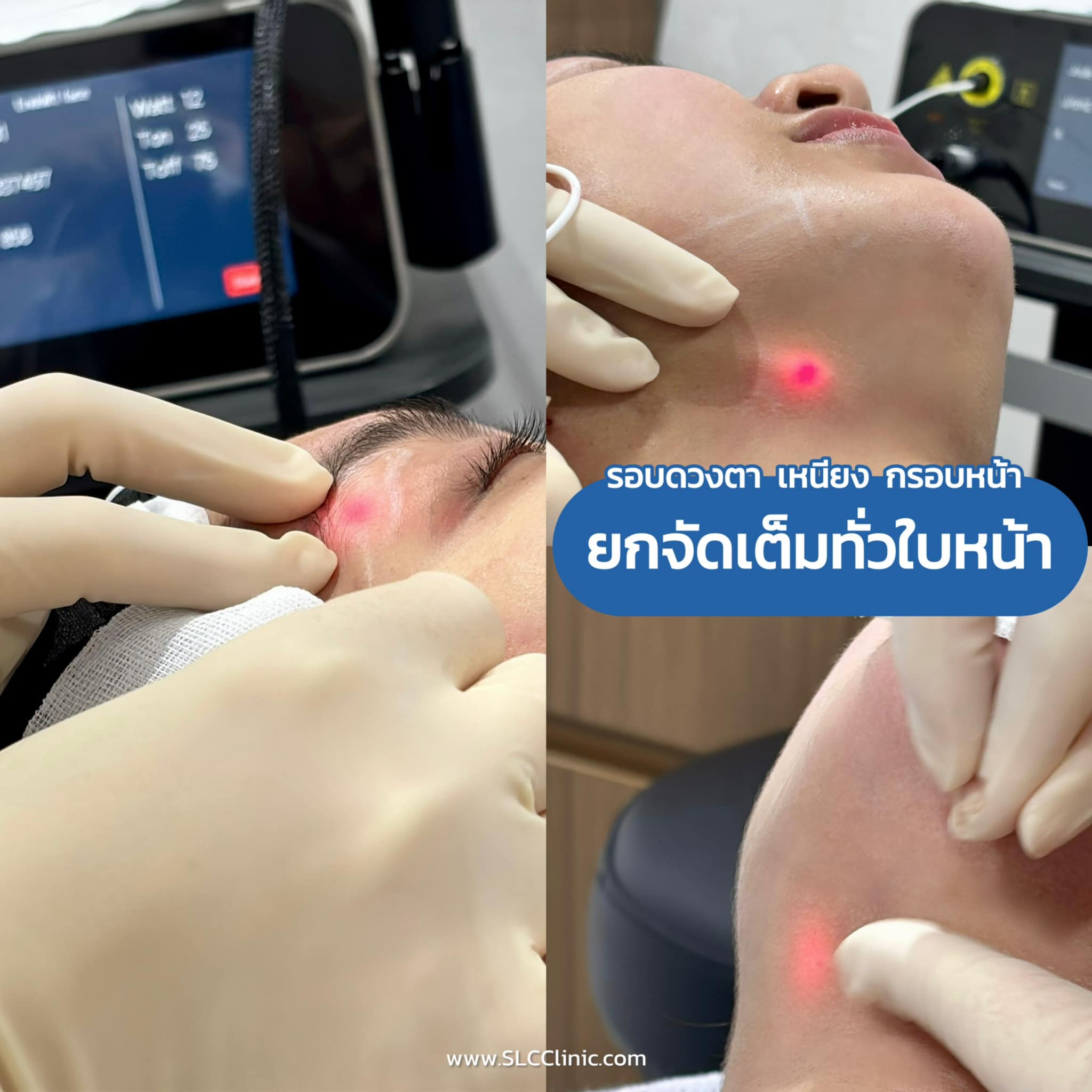 EndoliftX® ยกกระชับผิว กระชับต้นขา กระชับสะโพก สลายไขมัน