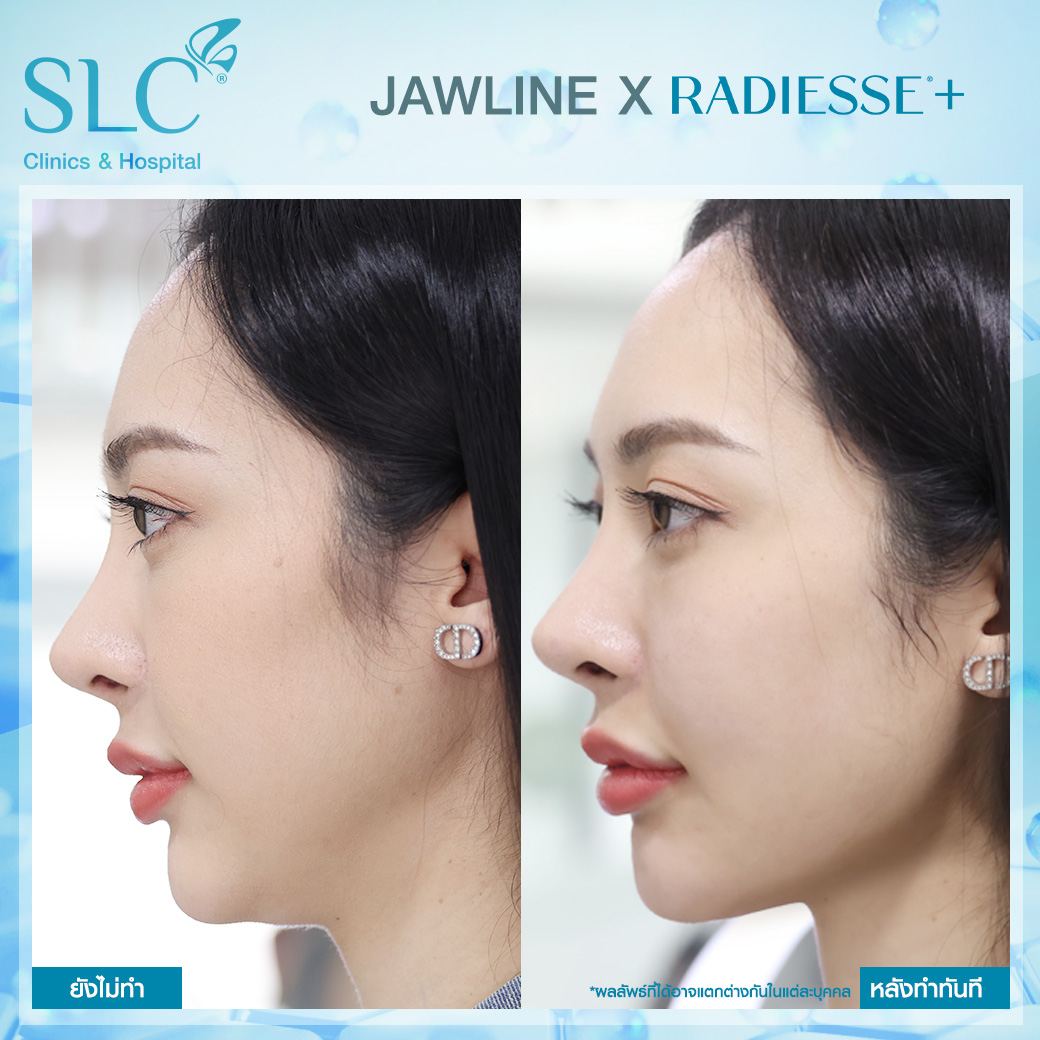 Ultherapy , Ultherapy SPT , ยกกระชับผิวหน้า , สร้างกรอบหน้า , สร้าง Jawline , Radiesse+ , ยกหน้าไม่ต้องผ่าตัด , อัลเทอราปี , ยกกระชับหน้า , ทำ Ultherapy , ยกกระชับ Ultherapy , ยกกระชับหน้าด้วย Ultherapy , ทำ Ultherapy เจ็บไหม , UltherapySLC