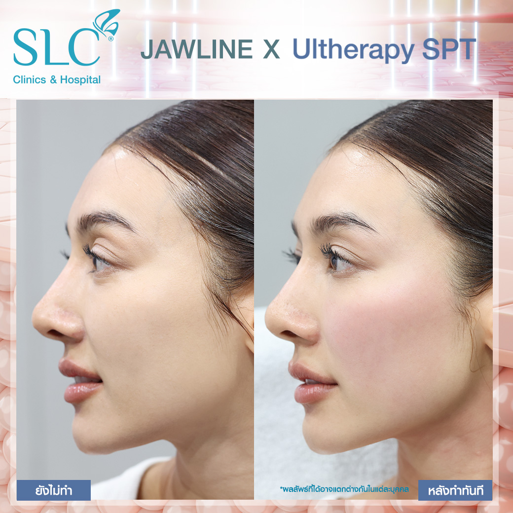 Ultherapy , Ultherapy SPT , ยกกระชับผิวหน้า , สร้างกรอบหน้า , สร้าง Jawline , Radiesse+ , ยกหน้าไม่ต้องผ่าตัด , อัลเทอราปี , ยกกระชับหน้า , ทำ Ultherapy , ยกกระชับ Ultherapy , ยกกระชับหน้าด้วย Ultherapy , ทำ Ultherapy เจ็บไหม , UltherapySLC