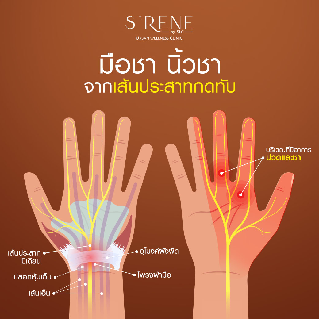 มือชานิ้วชาจากเส้นประสาทกดทับ,มือชา นิ้วชา,มือชา,นิ้วชา,Magnetic Stimulation,เครื่องMagnetic Stimulation,เส้นประสาทถูกกดทับ,อาการมือชา,อาการนิ้วชา,นิ้วชา มือชา,นิ้วชาเกิดจากอะไร,รักษาอาการมือชา,รักษาอาการนิ้วชา,รักษามือชานิ้วชา,ปลายประสาทอักเสบ