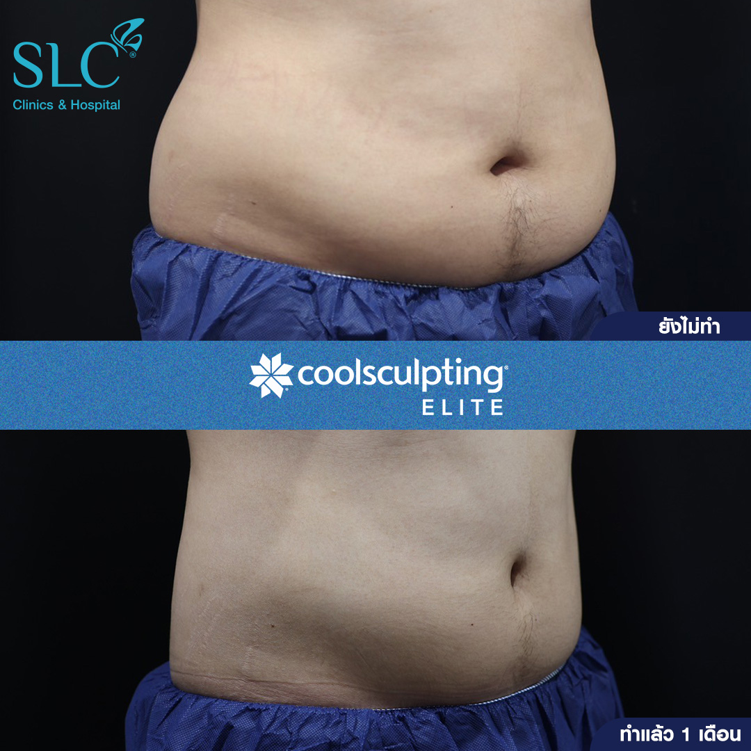 ลดพุงหมาน้อย, Coolsculpting® ELITE, Coolsculpting, ลดพุง, ลงพุงลดยังไง, วิธีลดพุงเร่งด่วน, วิธีลดพุงง่ายๆ, ลดพุงหน้าท้องเร่งด่วน,วิธีลดพุงแบบไม่ออกกําลังกาย,ลดพุงหมาน้อย