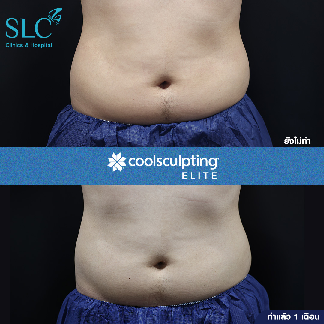 ลดพุงหมาน้อย, Coolsculpting® ELITE, Coolsculpting, ลดพุง, ลงพุงลดยังไง, วิธีลดพุงเร่งด่วน, วิธีลดพุงง่ายๆ, ลดพุงหน้าท้องเร่งด่วน,วิธีลดพุงแบบไม่ออกกําลังกาย,ลดพุงหมาน้อย