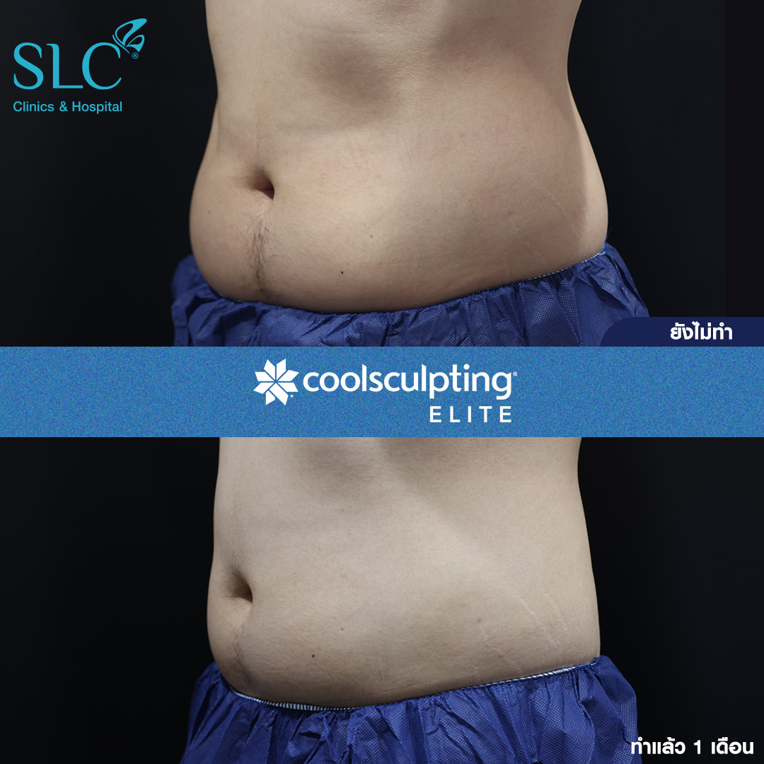 ลดพุงหมาน้อย, Coolsculpting® ELITE, Coolsculpting, ลดพุง, ลงพุงลดยังไง, วิธีลดพุงเร่งด่วน, วิธีลดพุงง่ายๆ, ลดพุงหน้าท้องเร่งด่วน,วิธีลดพุงแบบไม่ออกกําลังกาย,ลดพุงหมาน้อย