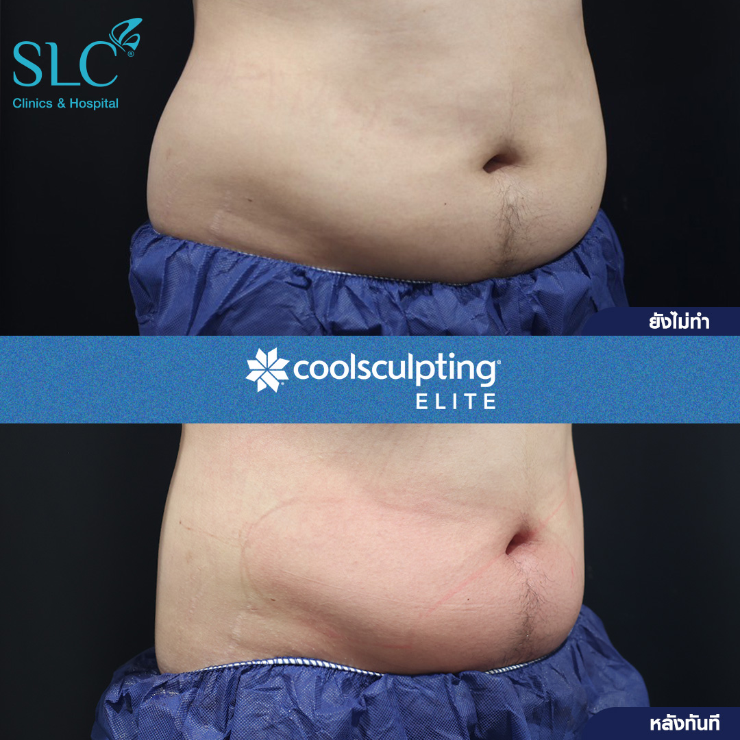 ลดพุงหมาน้อย, Coolsculpting® ELITE, Coolsculpting, ลดพุง, ลงพุงลดยังไง, วิธีลดพุงเร่งด่วน, วิธีลดพุงง่ายๆ, ลดพุงหน้าท้องเร่งด่วน,วิธีลดพุงแบบไม่ออกกําลังกาย,ลดพุงหมาน้อย