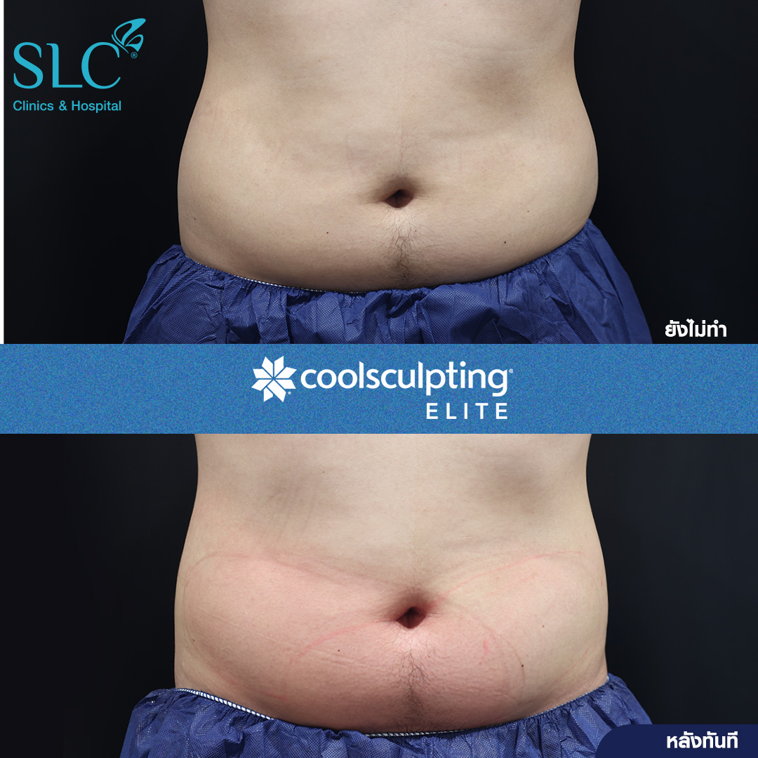 ลดพุงหมาน้อย, Coolsculpting® ELITE, Coolsculpting, ลดพุง, ลงพุงลดยังไง, วิธีลดพุงเร่งด่วน, วิธีลดพุงง่ายๆ, ลดพุงหน้าท้องเร่งด่วน,วิธีลดพุงแบบไม่ออกกําลังกาย,ลดพุงหมาน้อย