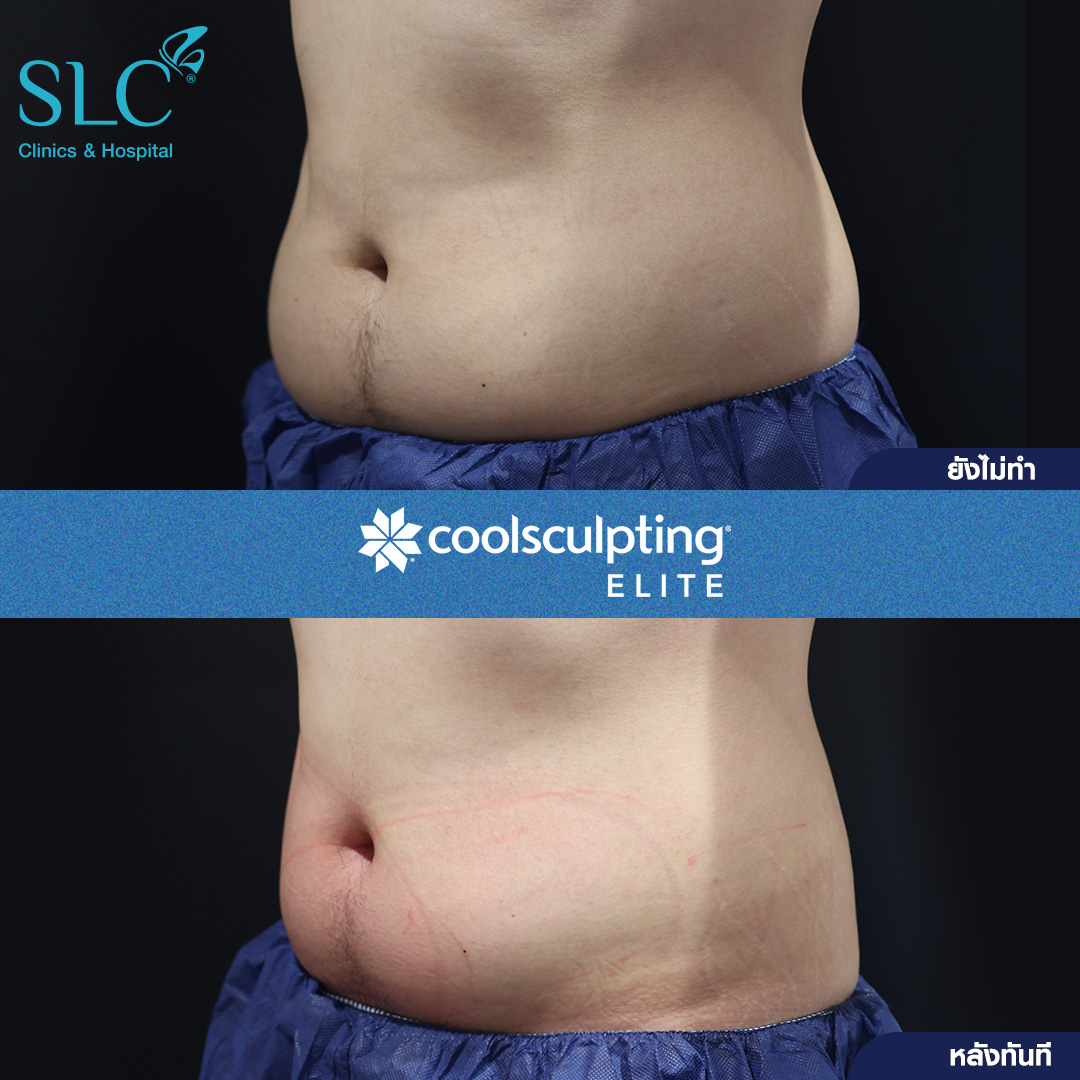 ลดพุงหมาน้อย, Coolsculpting® ELITE, Coolsculpting, ลดพุง, ลงพุงลดยังไง, วิธีลดพุงเร่งด่วน, วิธีลดพุงง่ายๆ, ลดพุงหน้าท้องเร่งด่วน,วิธีลดพุงแบบไม่ออกกําลังกาย,ลดพุงหมาน้อย