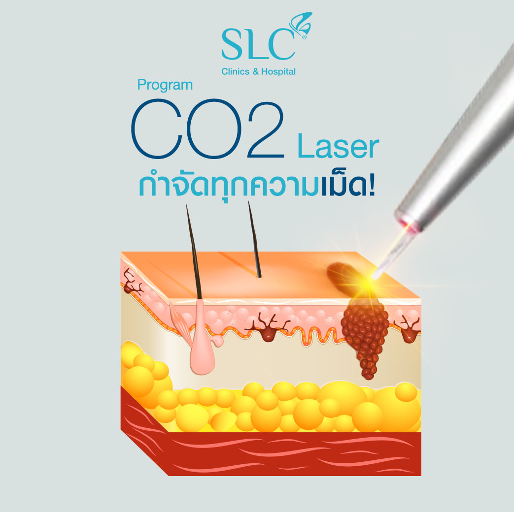 เลเซอร์ Co2, เลเซอร์ติ่งเนื้อ, ตัด ติ่งเนื้อ, คลินิก จี้ไฝ, กําจัด กระเนื้อ, ลบขี้แมลงวัน,co2 laser คือ, co2 laser ที่ไหนดี, ทํา fractional co2 laser, co2 laser กระเนื้อ