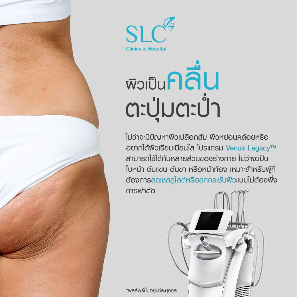 Venus Legacy™,  ผิวเปลือกส้ม, ลดเซลลูไลท์, กำจัดเซลลูไลท์, ลดผิวเปลือกส้ม