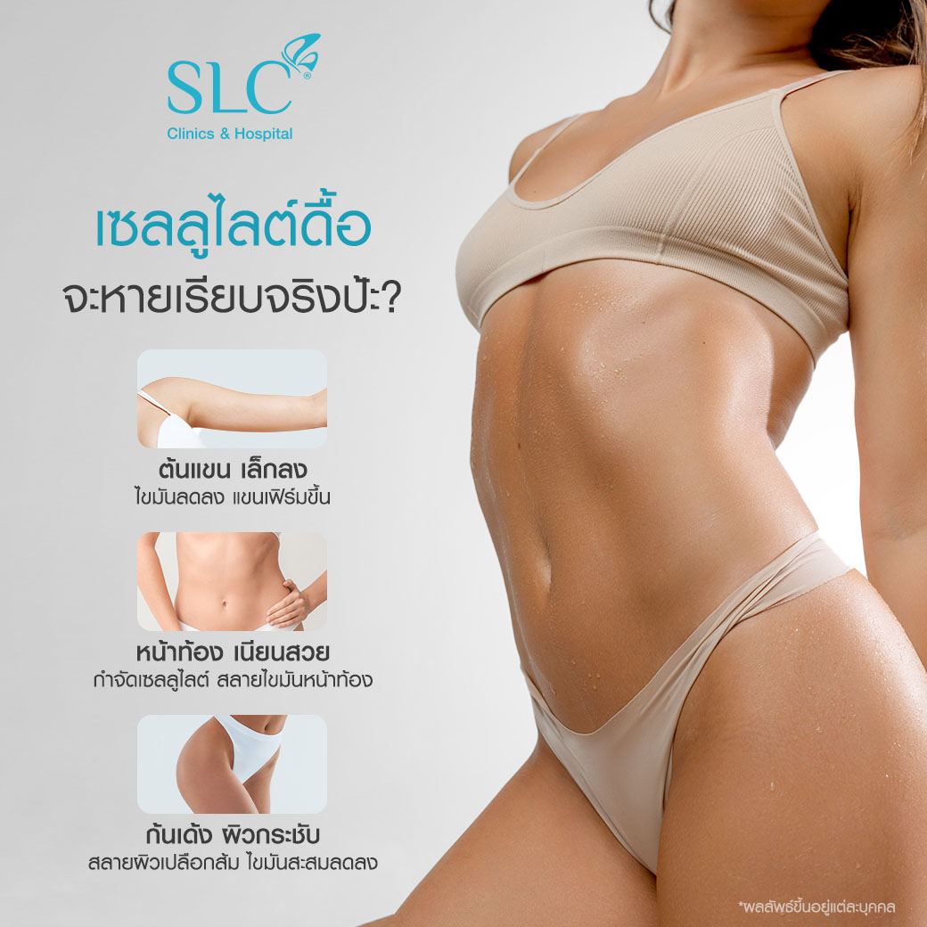 Venus Legacy™,  ผิวเปลือกส้ม, ลดเซลลูไลท์, กำจัดเซลลูไลท์, ลดผิวเปลือกส้ม